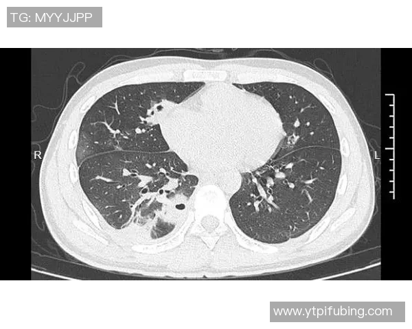 挤痘痘后肺部竟被啃出十多个空洞的惊人案例解析